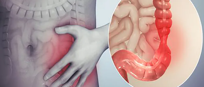 Sintomi e Cause colon irritabile