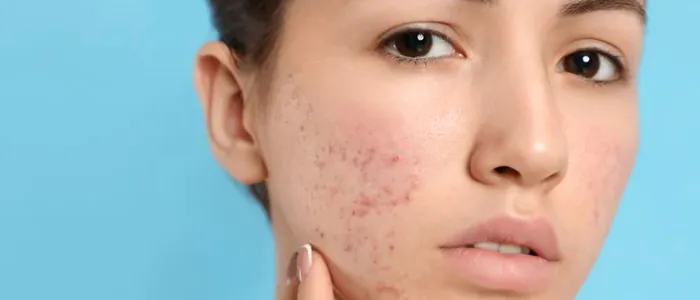 Come sconfiggere l'acne ormonale: cure e rimedi naturali