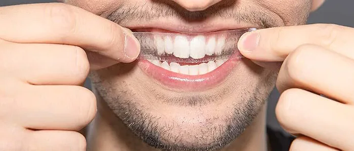 Strisce sbiancanti denti: fanno male?