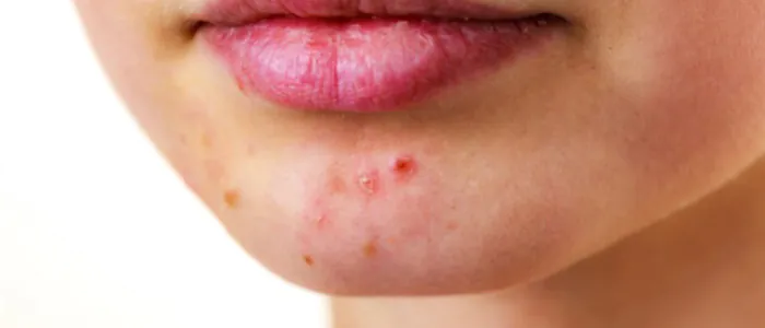 Come riconoscere l'acne ormonale